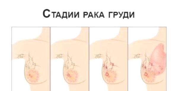 Виды операций на груди