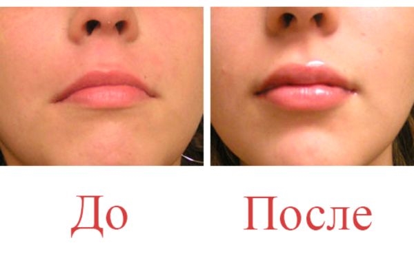 Особенности и результат от увеличения губ гиалуроновой кислотой