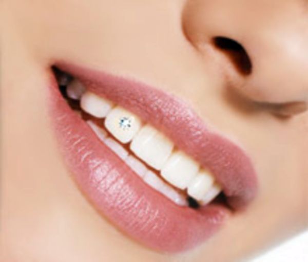 Зубные украшения. Украшение зубов бриллиантами, стразами и твинклами