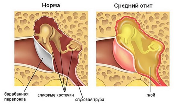 Характерные признаки воспаления среднего уха: диагностика. Как правильно лечить воспаление среднего уха: рекомендации врача