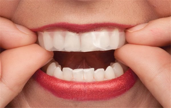 Лучший способ отбеливания зубов в домашних условиях. Как отбелить зубы в домашних условиях, технология и хитрости