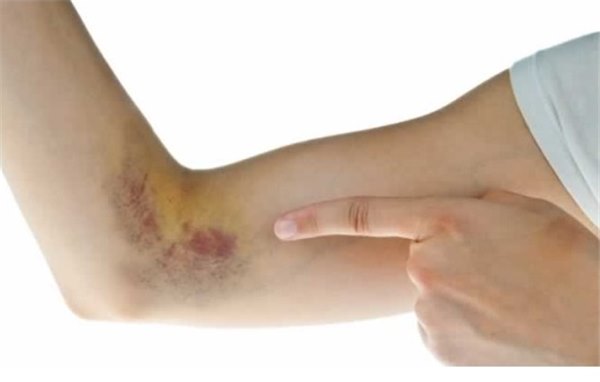 Синяк на руке – обычная вещь или опасная гематома. Почему появляются синяки на руке и что с ними делать?