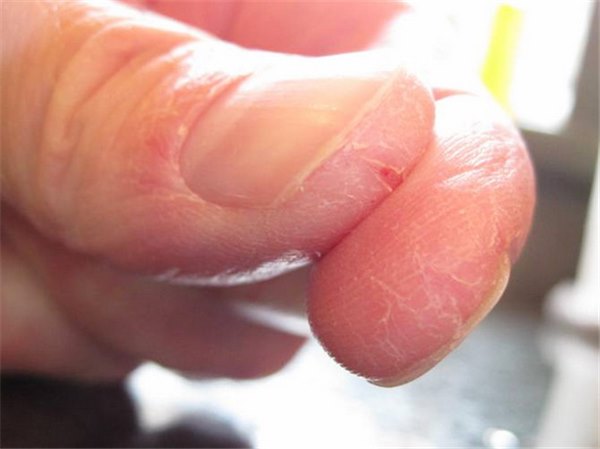 Трескается кожа на руках и ногах – причины. Почему трескается кожа на пальцах рук и ног, и какое лечение самое эффективное.