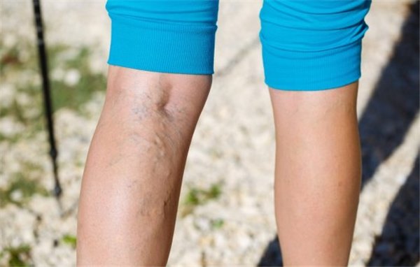 Варикоз на ногах – основные причины, первые признаки. Лечение и профилактика варикоза на ногах: как избежать осложнений
